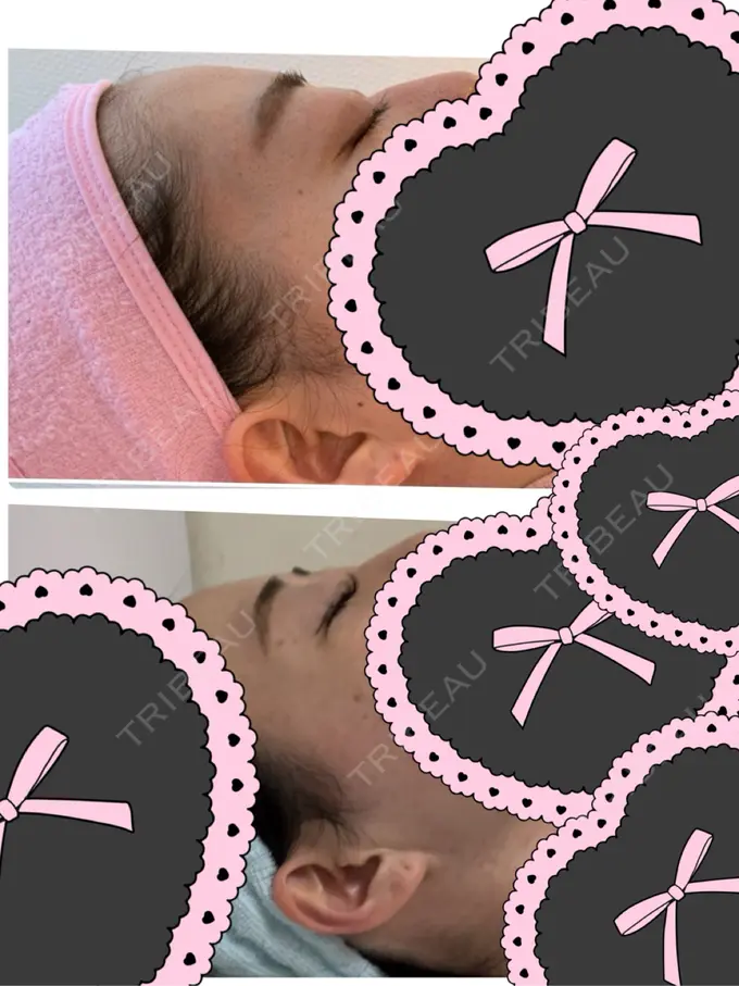 上まぶたの脂肪取り HAAB×DREAM BEAUTY CLINIC 大阪梅田院 AFTER メイン用