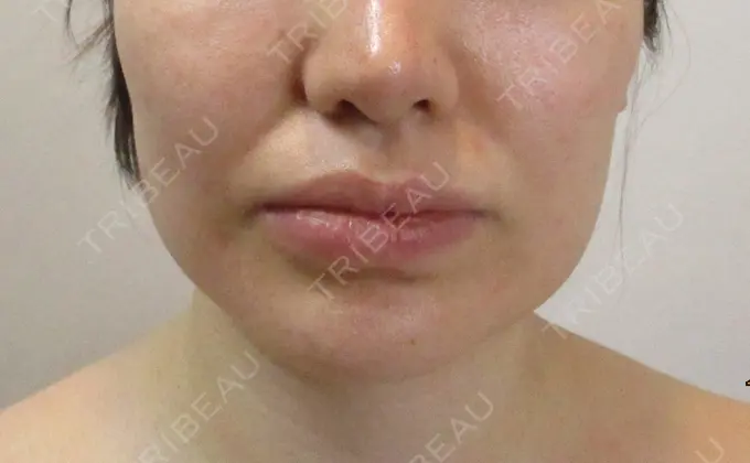 脂肪吸引（顔） / ボトックス（あご） / ヒアルロン酸注入（唇） / ヒアルロン酸溶解 藤・ナチュレ美容クリニック 恵比寿院 DAY 45 メイン用