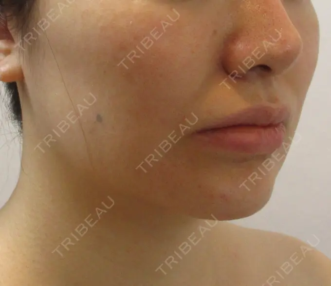 脂肪吸引（顔） / ボトックス（あご） / ヒアルロン酸注入（唇） / ヒアルロン酸溶解 藤・ナチュレ美容クリニック 恵比寿院 DAY 45 メイン用