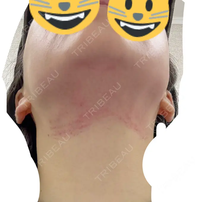 ハイフ（顔） / RF（高周波）たるみ治療 表参道メディカルクリニック 表参道院 DAY 0 メイン用