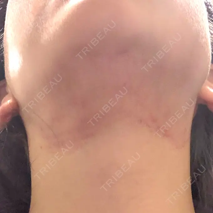 ハイフ（顔） / RF（高周波）たるみ治療 表参道メディカルクリニック 表参道院 DAY 1 メイン用