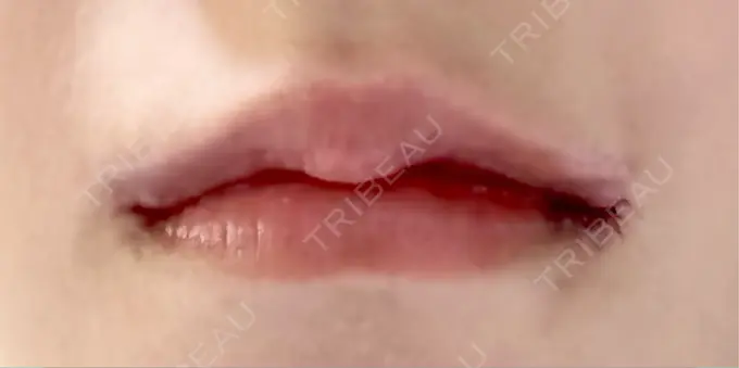 口角挙上 くさのたろうクリニック AFTER メイン用