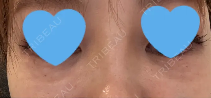 肌育注射（ジュベルックなど） GRACY TOKYO CLINIC【グレイシートウキョウクリニック】 AFTER メイン用