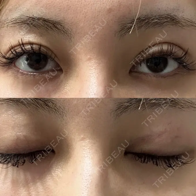 二重埋没 / クマ治療 ASTRA BEAUTY CLINIC DAY 746 メイン用