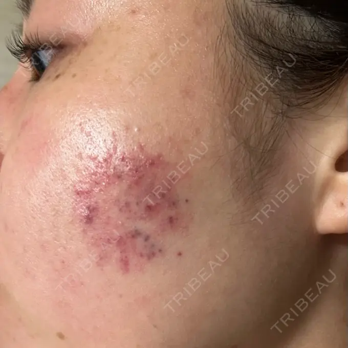 その他（肌） アーククリニック DAY 0 メイン用