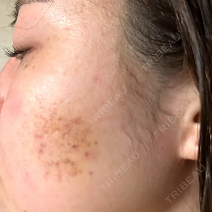 その他（肌） アーククリニック DAY 3 メイン用