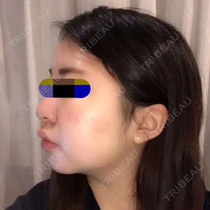 バッカルファット除去 / 脂肪吸引（顔） THE PLAN（ザ・プラン）美容整形外科・皮膚科 DAY 45 メイン用