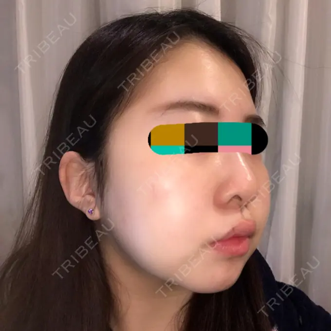 バッカルファット除去 / 脂肪吸引（顔） THE PLAN（ザ・プラン）美容整形外科・皮膚科 DAY 45 メイン用