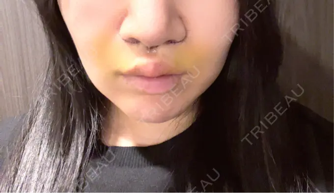 人中短縮 / 鼻柱下降・鼻唇角形成（猫手術） / その他（鼻） Otus Clinic 【オータスクリニック】 DAY 4 メイン用