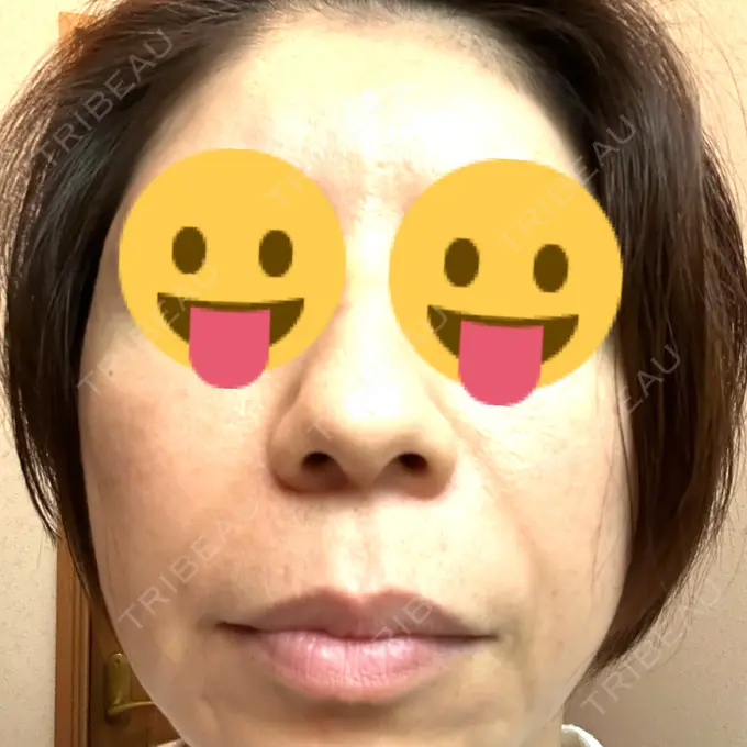 マイクロボトックス ルラ美容クリニック 千葉院 / ルラスキンクリニック 千葉院 DAY 5 メイン用