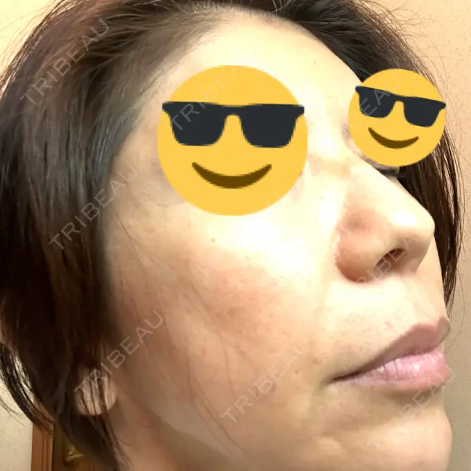 マイクロボトックス ルラ美容クリニック 千葉院 / ルラスキンクリニック 千葉院 DAY 5 メイン用