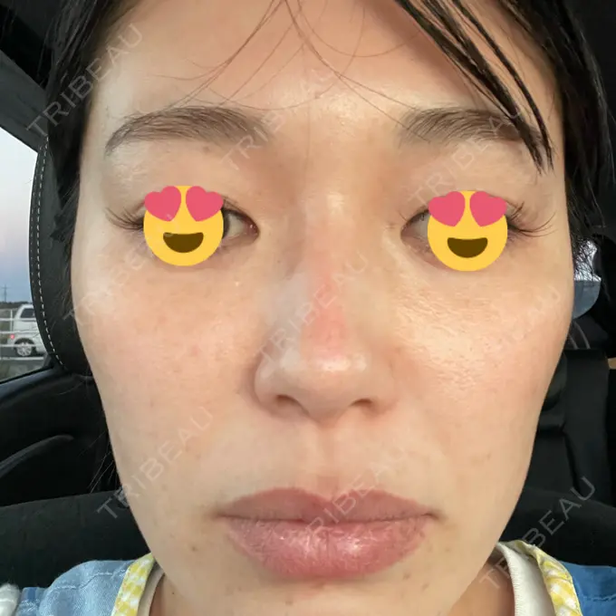 マイクロボトックス 日本美容・医療クリニック 六本木院 DAY 2 メイン用