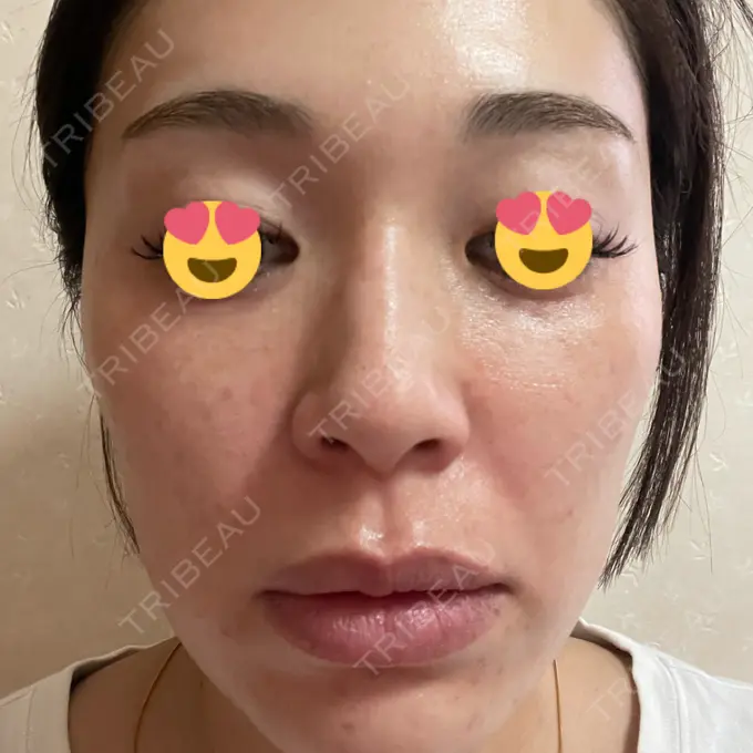 マイクロボトックス 日本美容・医療クリニック 六本木院 DAY 3 メイン用