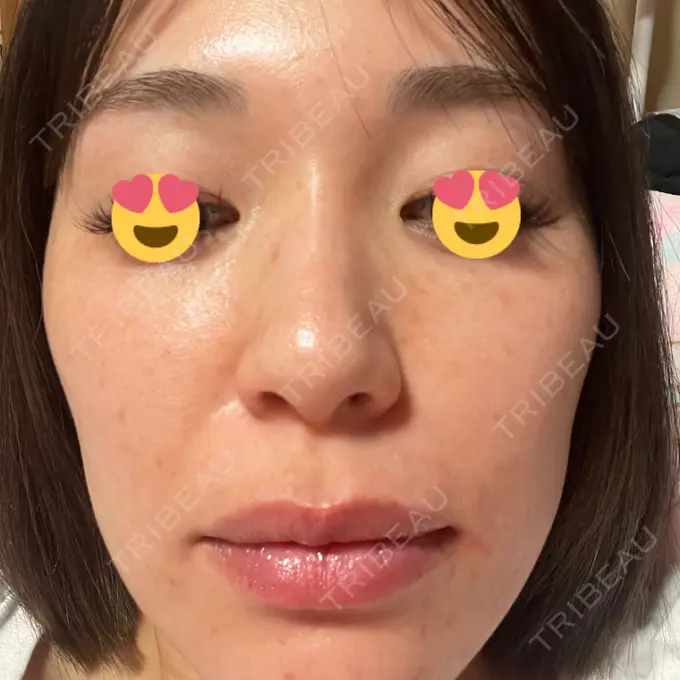 マイクロボトックス 日本美容・医療クリニック 六本木院 DAY 4 メイン用