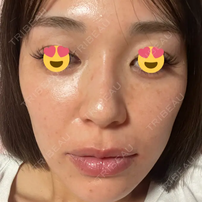 マイクロボトックス 日本美容・医療クリニック 六本木院 DAY 5 メイン用