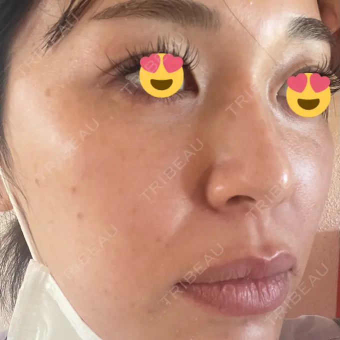 マイクロボトックス 日本美容・医療クリニック 六本木院 DAY 6 メイン用