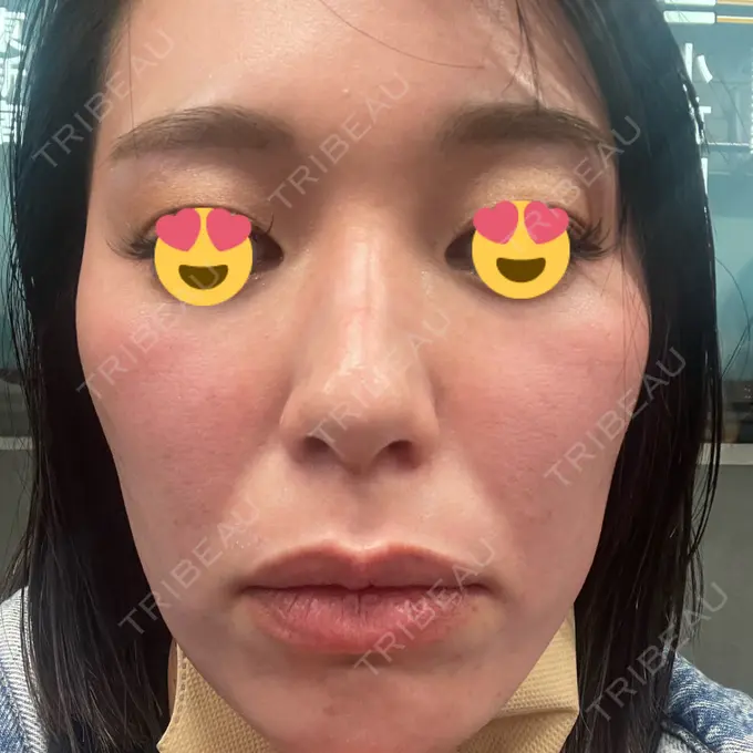 マイクロボトックス 日本美容・医療クリニック 六本木院 DAY 7 メイン用