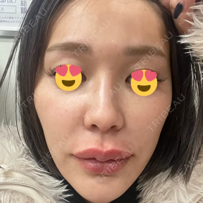 マイクロボトックス 日本美容・医療クリニック 六本木院 DAY 10 メイン用