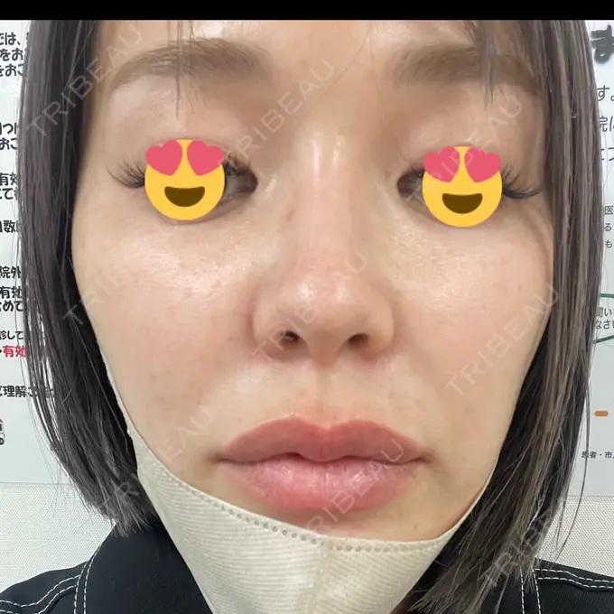 マイクロボトックス 日本美容・医療クリニック 六本木院 AFTER メイン用