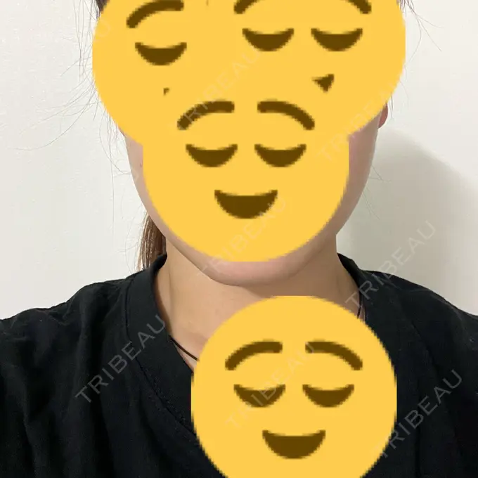 ボトックス（エラ・小顔） TCB東京中央美容外科 大分院 DAY 12 メイン用