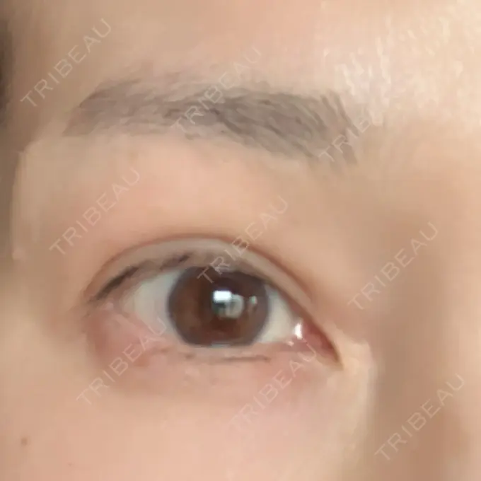 眉下切開 湘南美容クリニック 秋葉原院 DAY 1761 メイン用