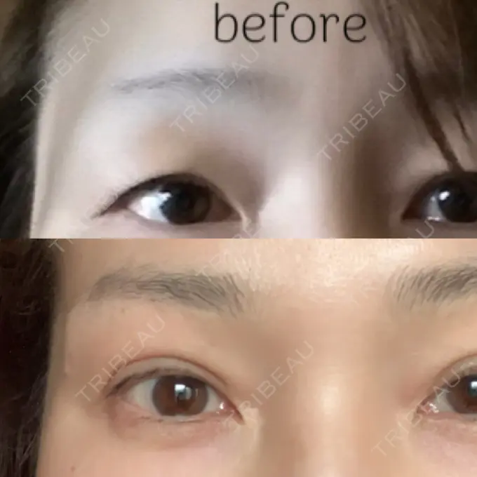 眉下切開 湘南美容クリニック 秋葉原院 DAY 1761 メイン用