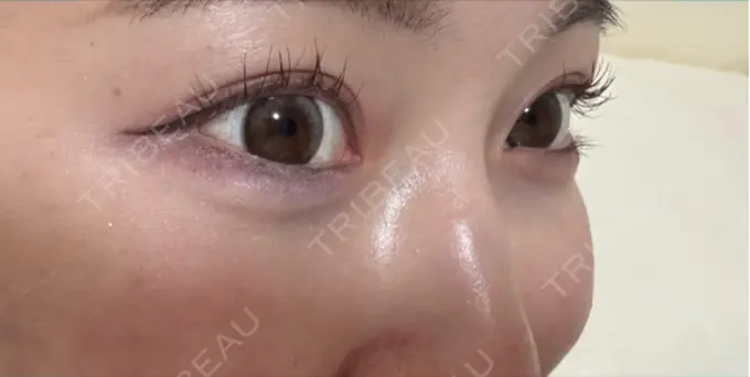 ヒアルロン酸注入（涙袋） AYANAフィラーズクリニック 渋谷院 DAY 2 メイン用