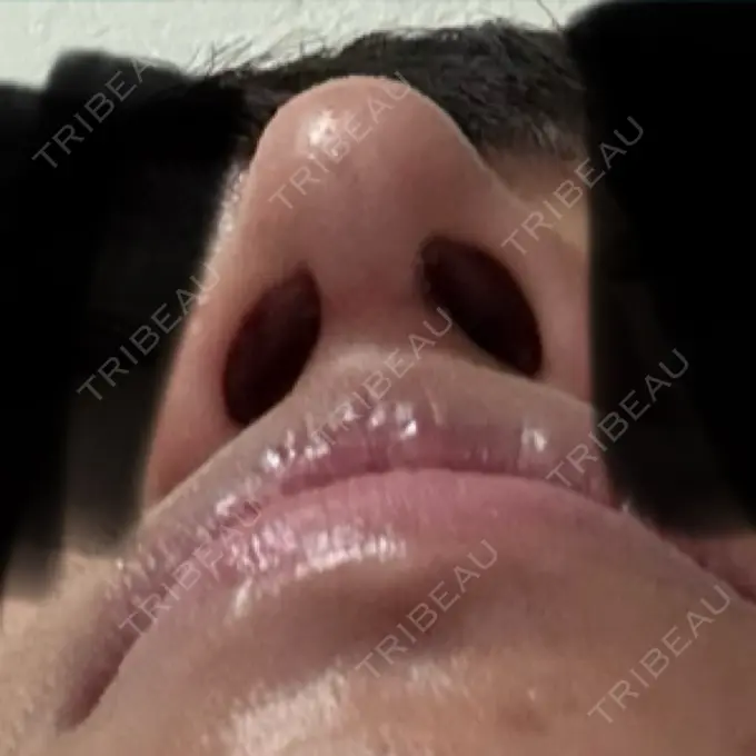 二重埋没 / 鼻尖形成（切開） / 口唇縮小術 / 目尻切開 / タレ目形成・グラマラスライン（切開） / 軟骨移植 / 眉間プロテーゼ アリエル美容クリニック 大宮院 DAY 35 メイン用