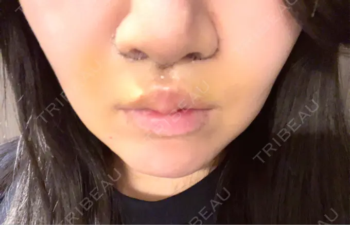 人中短縮 / 鼻柱下降・鼻唇角形成（猫手術） / その他（鼻） Otus Clinic 【オータスクリニック】 DAY 6 メイン用