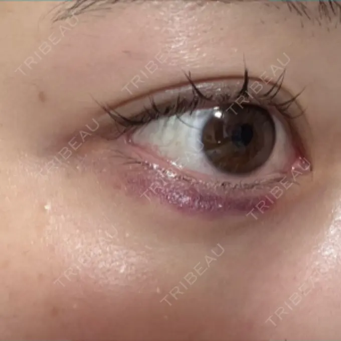 ヒアルロン酸注入（涙袋） AYANAフィラーズクリニック 渋谷院 AFTER メイン用