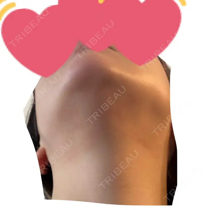 ハイフ（顔） / RF（高周波）たるみ治療 表参道メディカルクリニック 表参道院 DAY 2 メイン用