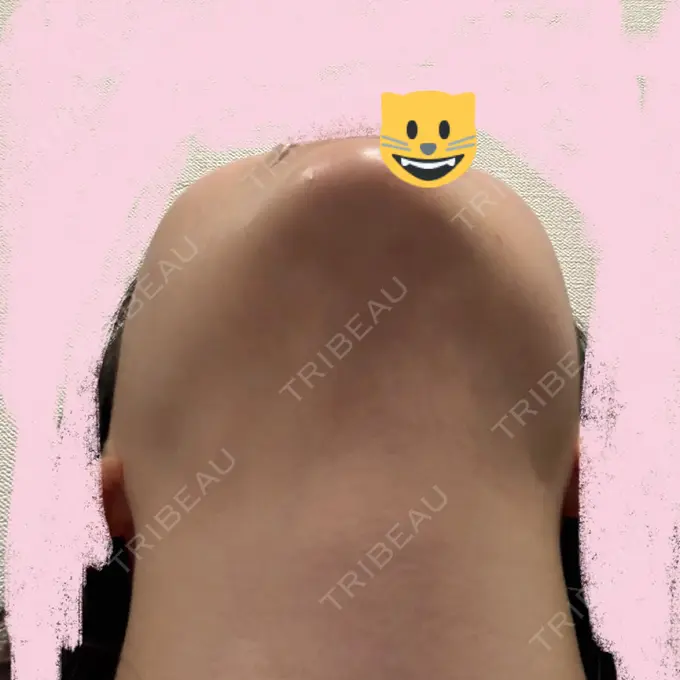 ハイフ（顔） / RF（高周波）たるみ治療 表参道メディカルクリニック 表参道院 DAY 3 メイン用