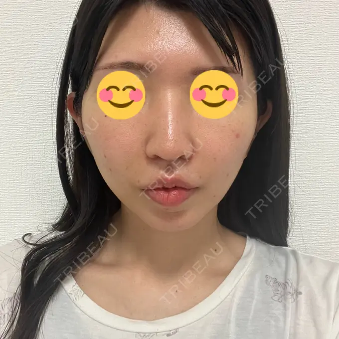 小鼻縮小（切開） / 人中短縮 / 鼻翼挙上 / ボトックス（ガミースマイル） Otus Clinic 【オータスクリニック】 DAY 45 メイン用