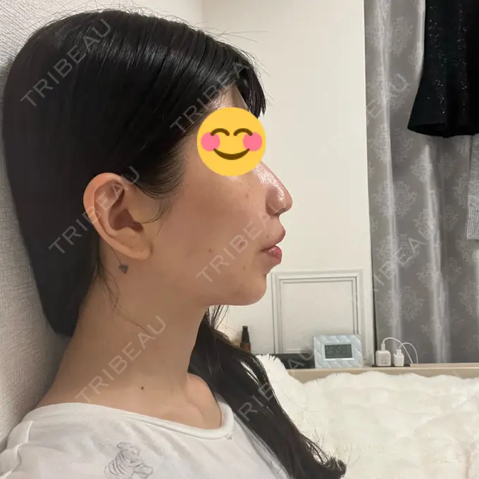 小鼻縮小（切開） / 人中短縮 / 鼻翼挙上 / ボトックス（ガミースマイル） Otus Clinic 【オータスクリニック】 DAY 45 メイン用