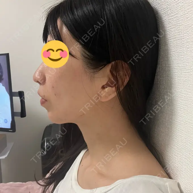 小鼻縮小（切開） / 人中短縮 / 鼻翼挙上 / ボトックス（ガミースマイル） Otus Clinic 【オータスクリニック】 DAY 45 メイン用