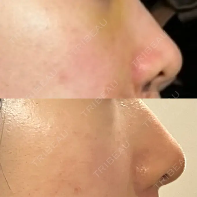 小鼻縮小（切開） 銀座S美容・形成外科クリニック DAY 35 メイン用