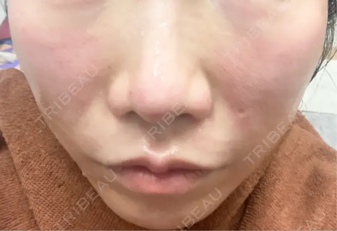 ボトックス（エラ・小顔） / ヴェルヴェットスキン おおたかの森ビューティークリニック DAY 0 メイン用