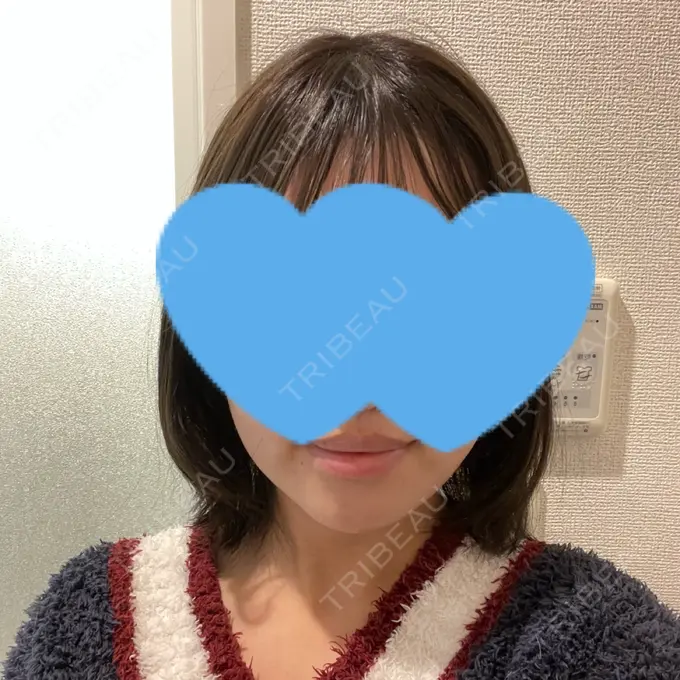 糸リフト / バッカルファット除去 / 脂肪吸引（顔） / ボトックス（エラ・小顔） アリエル美容クリニック 大宮院 DAY 20 メイン用