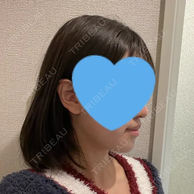 糸リフト / バッカルファット除去 / 脂肪吸引（顔） / ボトックス（エラ・小顔） アリエル美容クリニック 大宮院 DAY 20 メイン用