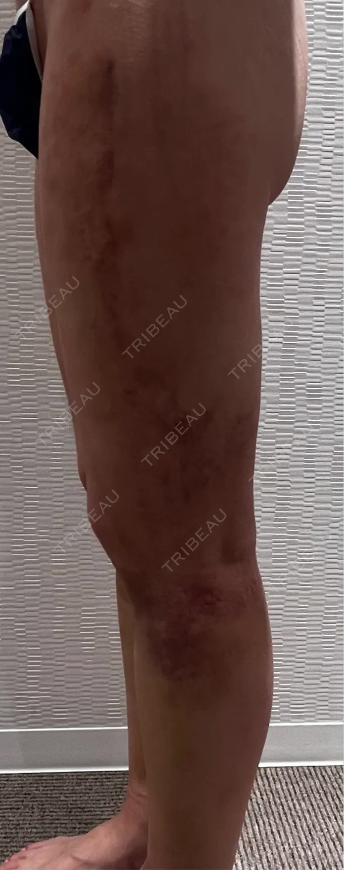 脂肪吸引（脚） / 豊胸（脂肪注入） Mods Clinic（モッズクリニック） 名古屋院 DAY 29 メイン用