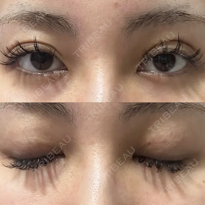 二重埋没 / クマ治療 ASTRA BEAUTY CLINIC DAY 749 メイン用