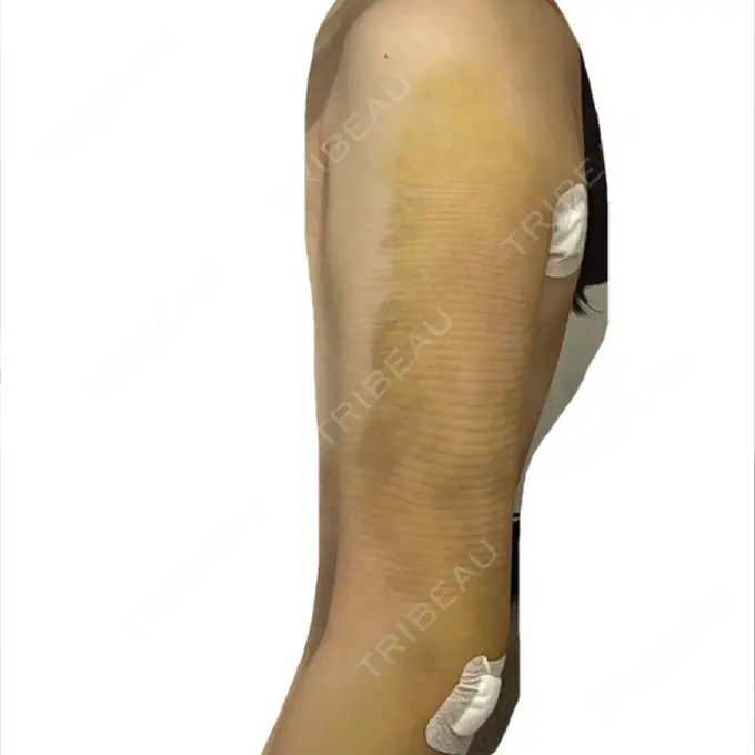 脂肪吸引（二の腕） / 脂肪吸引（肩） BBC銀座院 DAY 3 メイン用