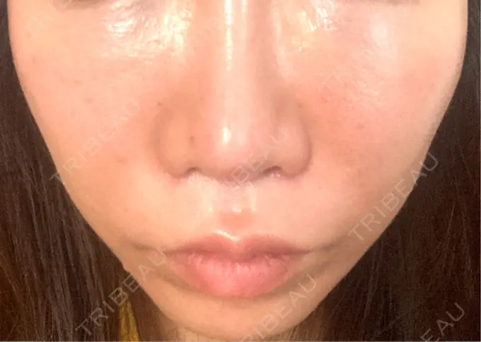 ボトックス（エラ・小顔） / ヴェルヴェットスキン おおたかの森ビューティークリニック DAY 1 メイン用