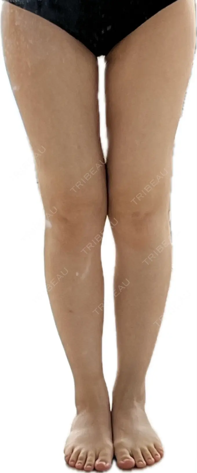 脂肪吸引（脚） Mods Clinic（モッズクリニック） 名古屋院 DAY 127 メイン用