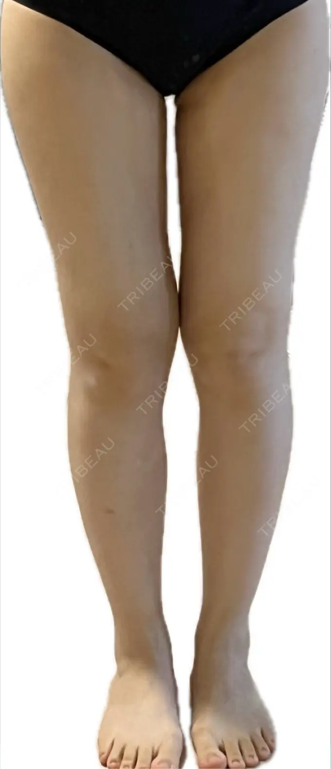 脂肪吸引（脚） Mods Clinic（モッズクリニック） 名古屋院 DAY 129 メイン用