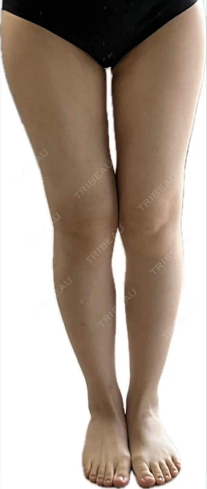 脂肪吸引（脚） Mods Clinic（モッズクリニック） 名古屋院 DAY 130 メイン用