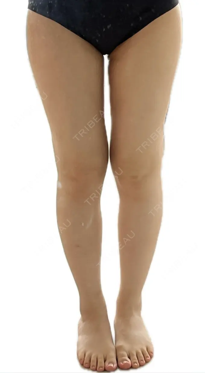 脂肪吸引（脚） Mods Clinic（モッズクリニック） 名古屋院 DAY 134 メイン用