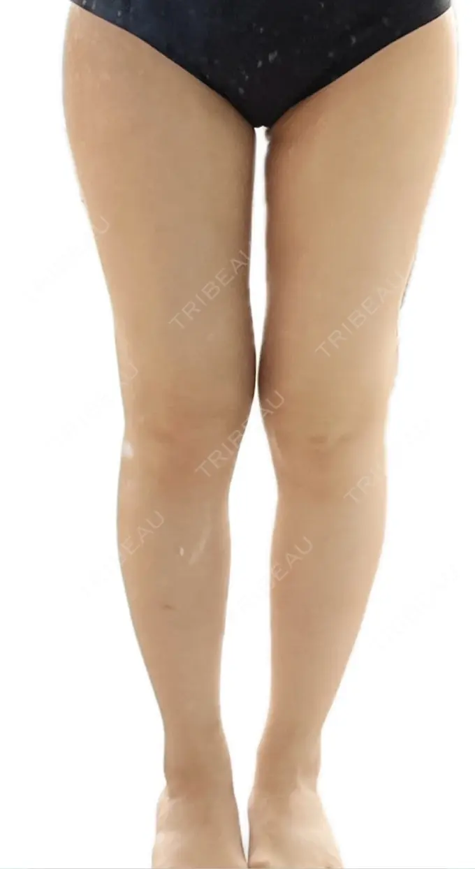 脂肪吸引（脚） Mods Clinic（モッズクリニック） 名古屋院 DAY 135 メイン用