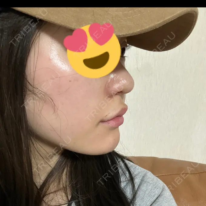 ヒアルロン酸注入（鼻翼基部） THE FIRST CLINIC 町田院 DAY 14 メイン用