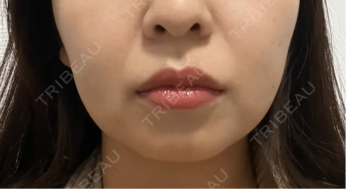 RF（高周波）たるみ治療 BISIN GINZA CLINIC DAY 1 メイン用